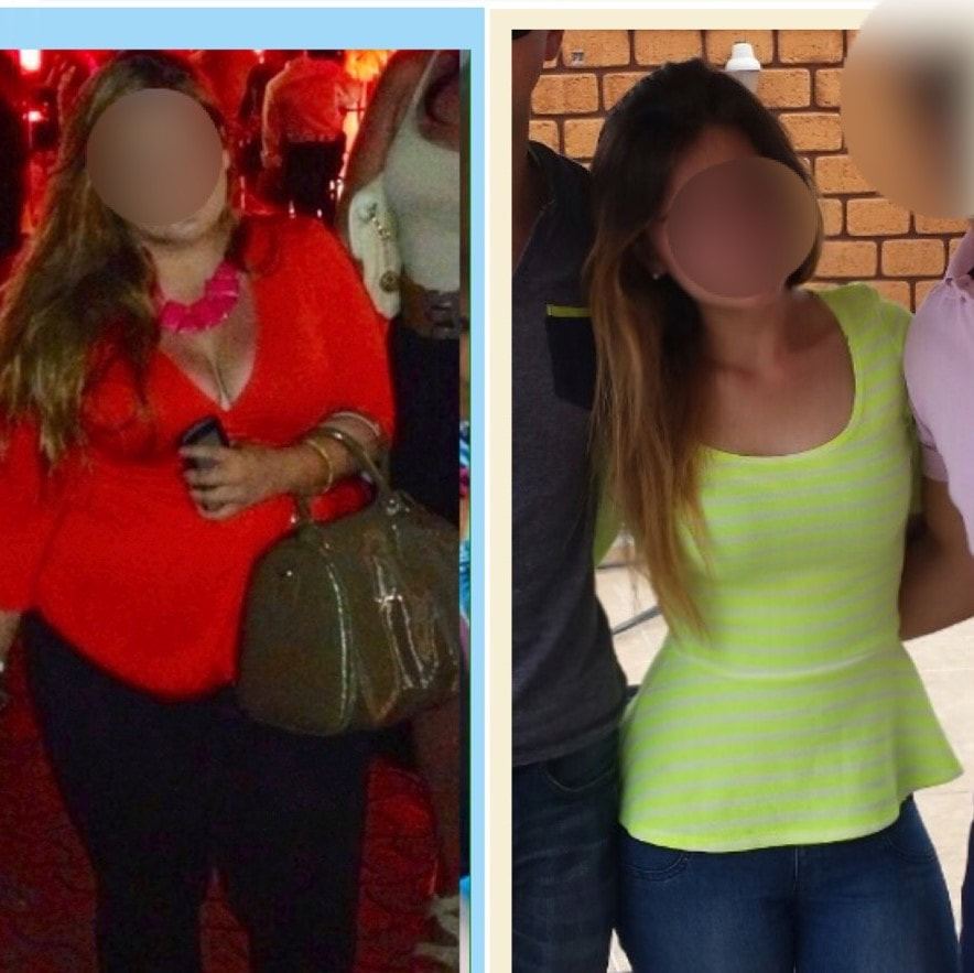 Paciente antes y después de su tratamiento, caso 3
