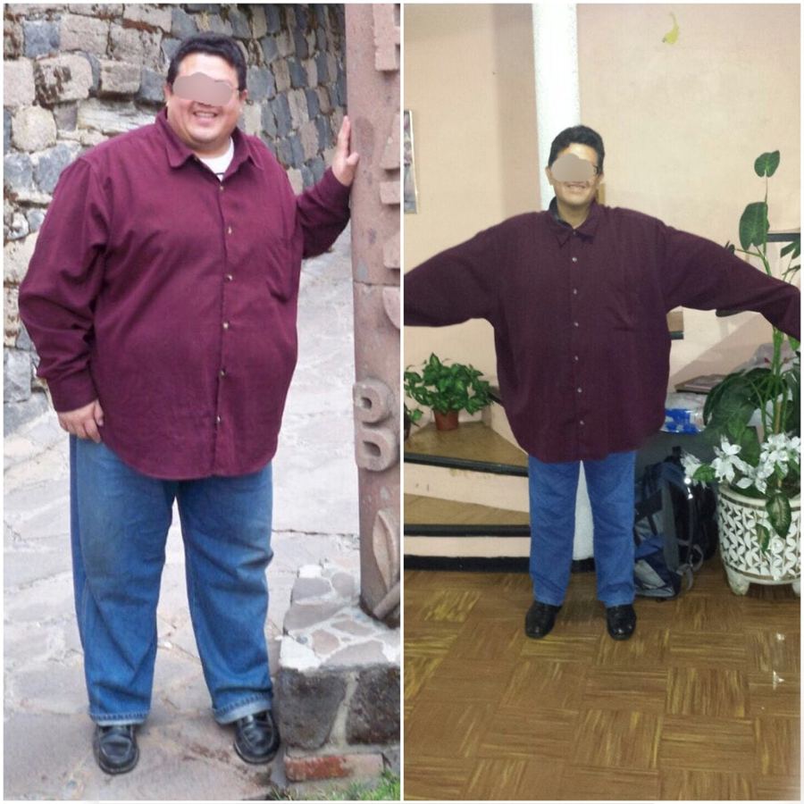 Paciente antes y después de su tratamiento, caso 14